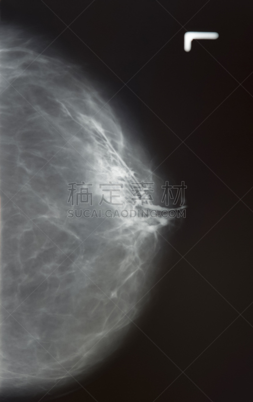 x光,输乳管,石灰质的,乳癌,健康保健,癌症,女人,x光片