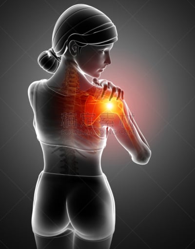 肩,痛苦,女人,僵硬的肩膀,肘,炎症,x光,面部扭曲,生物医学插图
