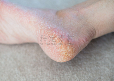 足,破碎的,特写,成年的,仅成年人,青年人,皮肤,手指,四肢
