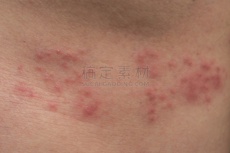 带状疱疹,特写,皮肤,抗组胺剂,表皮细胞,allergic vasculitis,水痘,疱疹,肿胀的