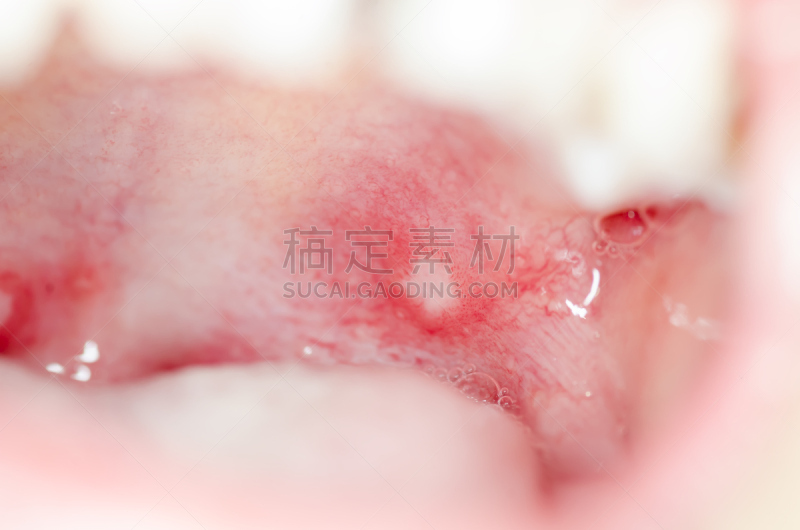 人的嘴,里面,溃疡,水平画幅,真菌性口炎,舌头,特写,开着的,白色,细菌