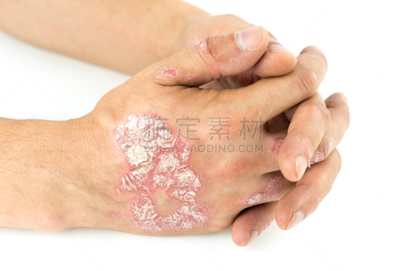 牛皮廯,斑块,手,白色背景,男性,脱氧核糖核酸,皮疹,分离着色,眼罩,生病