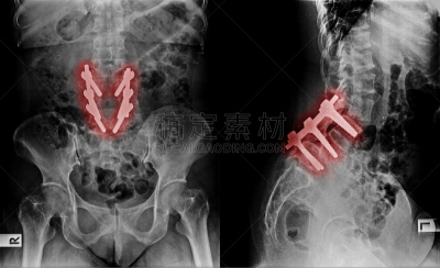 脊柱,螺丝,disk,定海神针,x光片,变质的,药,脊骨神经科矫正,神经系统,水平画幅