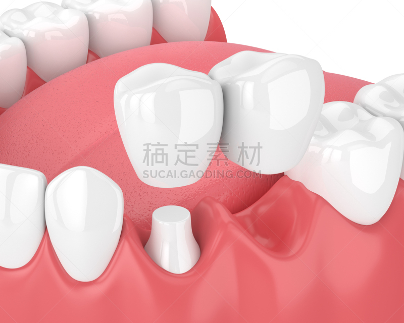 悬臂桥,三维图形,口腔卫生,合成图像,人造的,牙冠,假牙,牙龈,舌头,水平画幅