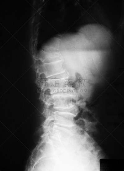 x光片,视角,加燃料,垂直画幅,身体受伤,人类骨架,人类肌肉,科学,膀胱,偏远的
