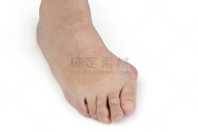 拇趾囊肿胀,足,平视角,仅成年人,肿胀的,白色,女人,仅一个女人,皮肤病学