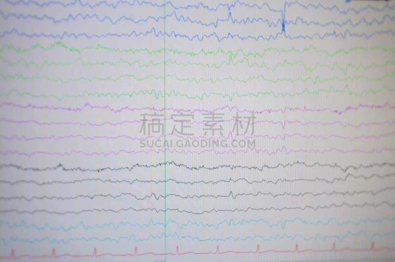 脑部,电,脑电图,显示器,奇异的,神经系统,水平画幅,癫痫症,科学,文档