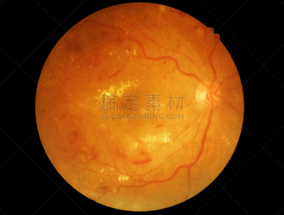 视网膜,糖尿病,洞,室内管弦乐队,水平画幅,拉格啤酒,视力,验光师,船