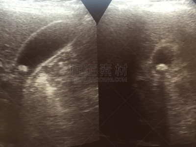 超声波,胆囊,胆石,健康保健,医学检测,医药职业,声谱仪,医疗流程,医疗器械