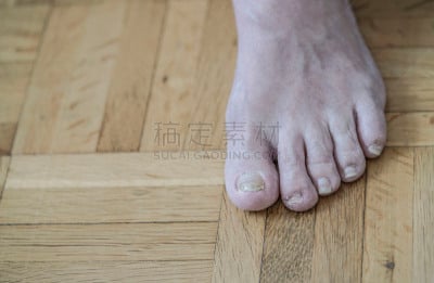 真菌,钉子,损坏的,修改系列,脚气,化疗药物,身体受伤,水平画幅,古老的