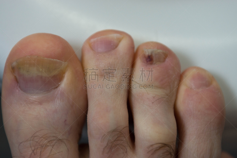 趾甲,损坏的,选择对焦,身体受伤,水平画幅,人类脚趾,白人,瘀伤,特写,运动员
