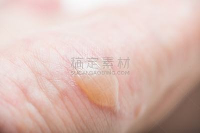 水彩画颜料,水泡,身体受伤,水平画幅,痛苦,瘢痕瘤,疤,人,烧毁的,背景