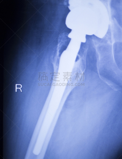 人工髋关节,脊柱,医学扫描,x光,垂直画幅,身体受伤,人造的,科学,骨盆,替代