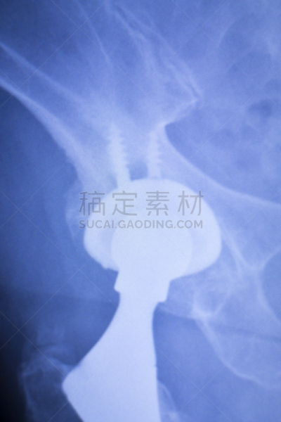 人工髋关节,脊柱,医学扫描,x光,垂直画幅,身体受伤,人造的,科学,骨盆,替代