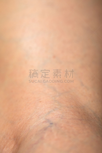 腿,蛛状静脉曲张,年龄,成年的,仅成年人,老年人,青年人,血流动,静脉曲张