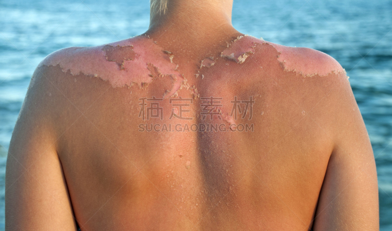 皮肤,干的,特写,后背,太阳,女性,剥落,灼伤,抓