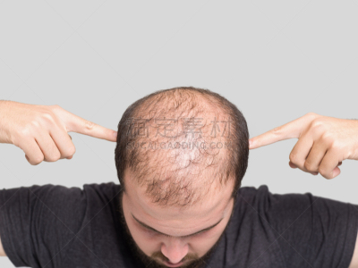 非全秃,青年男人,正面视角,发际线后移,秃头,水平画幅,白人,特写,男性,仅男人