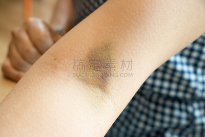 手臂,身体受伤,瘀伤,背景,女性,成年的,毛细血管,皮肤,四肢