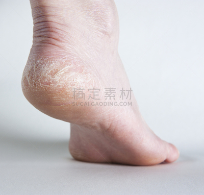 足,破碎的,侧面视角,水平画幅,阿基里斯,在底端,皮肤,干的,损坏的