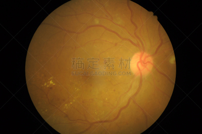 糖尿病,视网膜,健康保健,验光师,显微镜,焦点,洞,视网膜病,室内管弦乐队