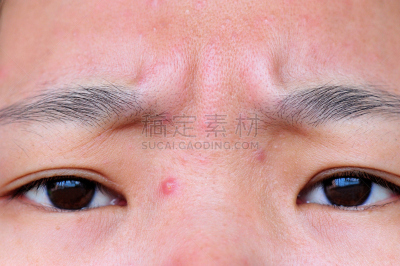 人的脸部,粉刺,疙瘩,正面视角,青少年,青春期,水平画幅,人的眼睛,青年人,看