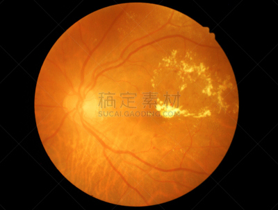 视网膜,糖尿病,洞,室内管弦乐队,水平画幅,拉格啤酒,视力,验光师,船