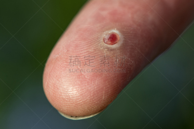 手指,生脓的,血管瘤,良性肿瘤,淋巴结,维管束,健康保健,皮肤病学,肮脏的,病毒