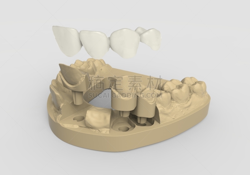假牙,三维图形,假牙粘合剂,牙移植,假肢,牙科诊所,牙科设备,牙医,磨牙,补牙
