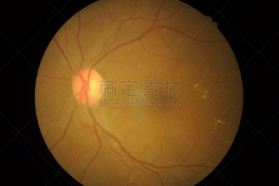 视网膜,糖尿病,健康保健,视网膜病,器官底部,角膜,室内管弦乐队,验光师,显微镜,焦点