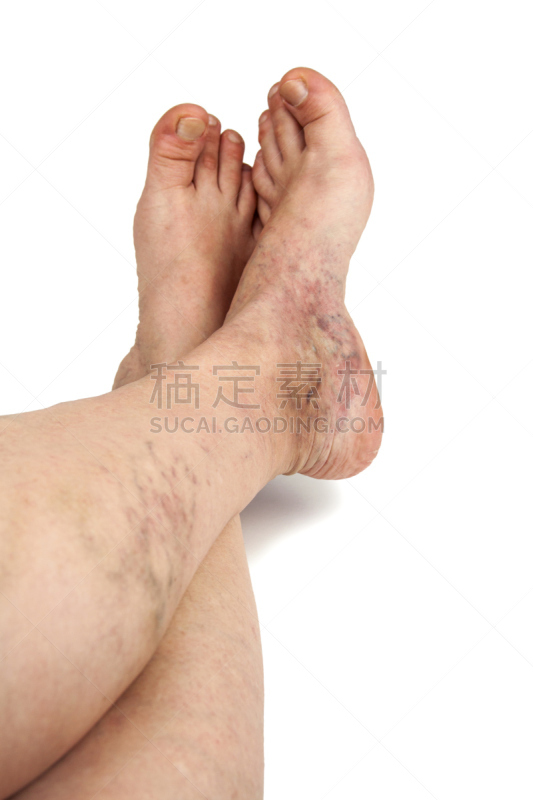 静脉曲张,垂直画幅,蛛状静脉曲张,四肢,腰部以下,腿,白人,肿胀的,白色