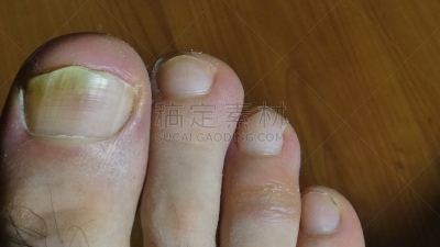 钉子,腿,痛苦,甲真菌病,寒冷,健康保健,部分,药,鞋子,女人