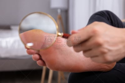 拿着,男人,足,放大镜,前面,脚印,健康,跖疣,设备用品,真菌