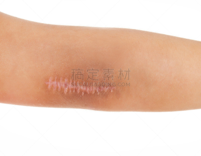 疤,皮肤,瘢痕瘤,断胳膊,肘,皮肤病学,四肢,水平画幅,残酷的,白人
