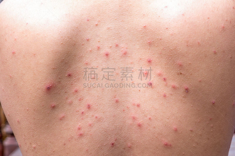大特写,水痘,皮疹,水平画幅,疤,白人,疙瘩,特写