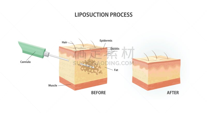 抽脂术,健康保健,塑胶,医疗流程,损失,自然美,绘画插图,问题,机件