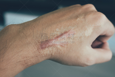 瘢痕瘤,疤,皮肤,易接近性,健康保健,部分,药,泰国,细胞,女人