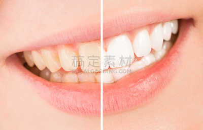 人的牙齿,修改系列,假牙,牙齿,黄色,牙医,牙齿美白,美,水平画幅,人的嘴