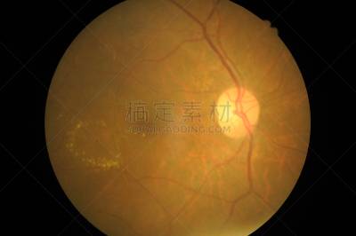 视网膜,糖尿病,健康保健,视网膜病,器官底部,角膜,室内管弦乐队,验光师,显微镜,焦点