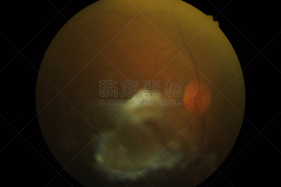 视网膜,糖尿病,健康保健,视网膜病,器官底部,角膜,室内管弦乐队,验光师,显微镜