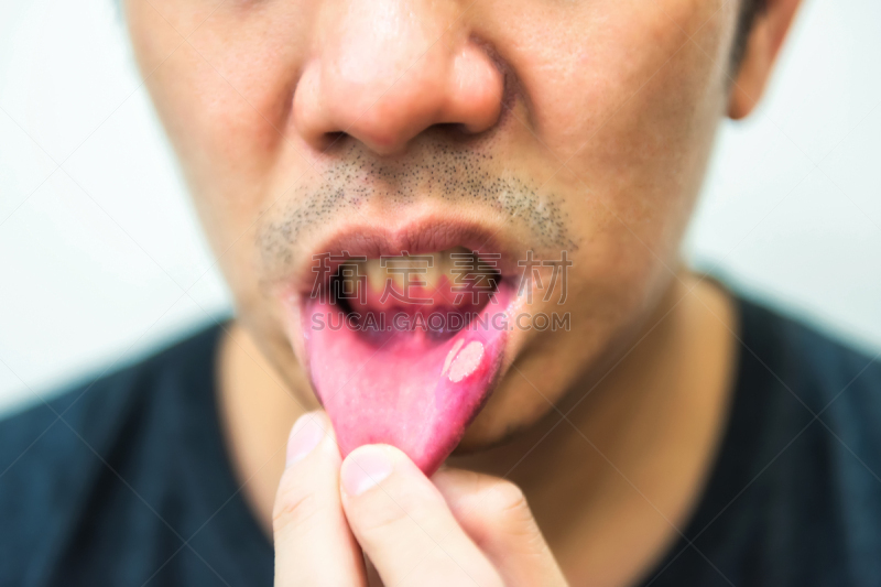 痛苦,人的嘴,溃疡,男人,丑陋,留白,水平画幅,皮肤病学,健康保健,疱疹