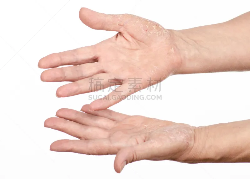 牛皮廯 女性 手 健康保健 皮炎 药 皮肤病学 一个人 女人 凌乱图片素材下载 稿定素材