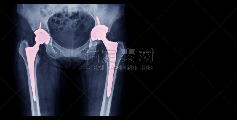 骨关节炎,人造的,痛苦,臀,人工髋关节,股骨,古老的,金属,骨盆,过度劳累