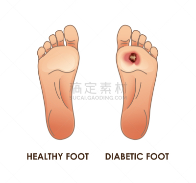 矢量,足,糖尿病,绘画插图,部分,植物枯斑,痛苦