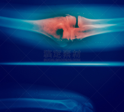 骨骼,x光,健康保健,背景聚焦,特写,射线成像,结核杆菌,人类肺脏,人类心脏,中间部分