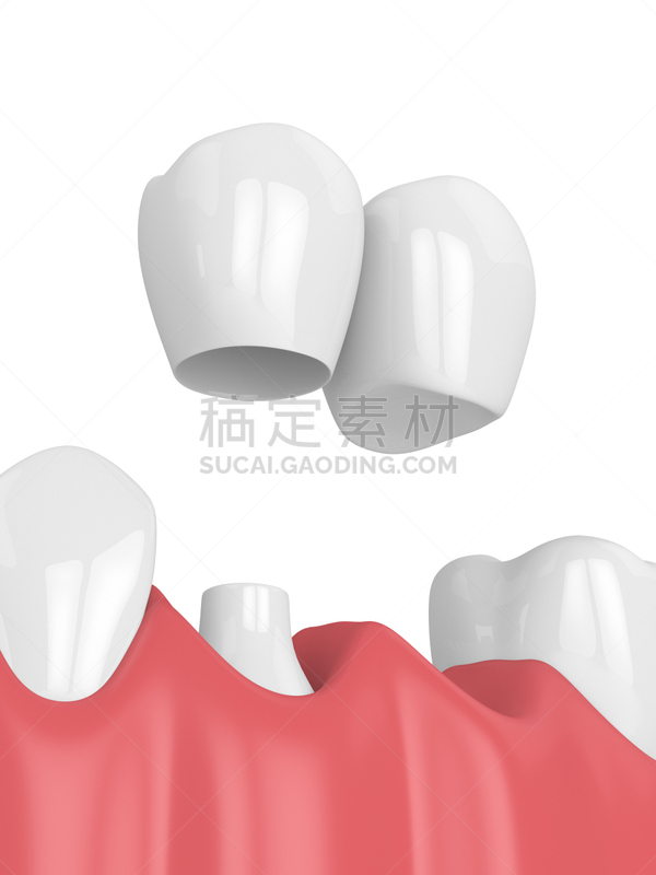 悬臂桥,三维图形,口腔卫生,垂直画幅,合成图像,人造的,牙冠,假牙,牙龈,舌头
