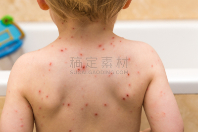 水痘,幼儿,身体受伤,学龄前,水平画幅,白人,男性,白色,背面视角,肩