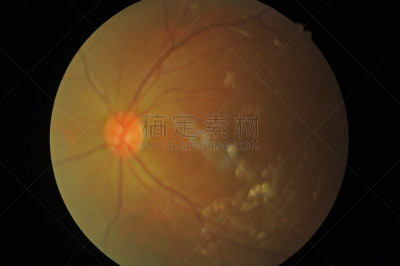 视网膜,糖尿病,健康保健,视网膜病,器官底部,角膜,室内管弦乐队,摄影,缺血,出血