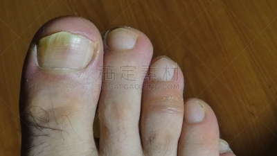 钉子,腿,痛苦,甲真菌病,寒冷,健康保健,部分,药,鞋子,女人