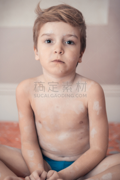 男孩,水痘,小的,垂直画幅,注视镜头,白人,疙瘩,男性
