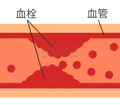 血栓,横截面,狭窄的,健康保健,心肌梗塞,绘画插图,动脉硬化,问题,日本,心血管系统